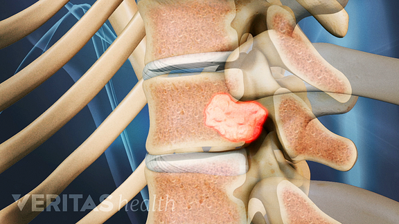 breast cancer in the spinal column Breast cancer in the spinal column